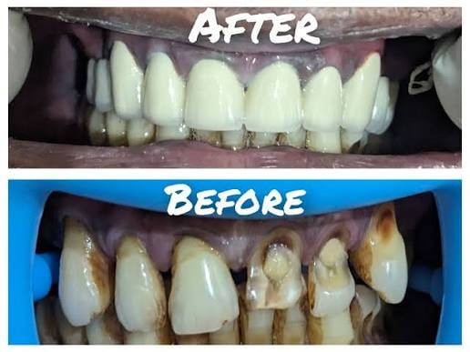Happy Patient - Cosmetic Dentistry West Delhi New Delhi